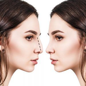 نتیجه عمل بینی قبل و بعد از جراحی رینوپلاستی
