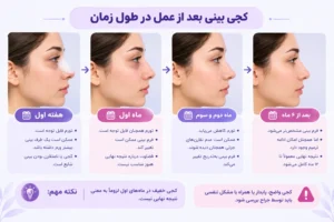 روند کج دیده شدن بینی بعد از عمل در طول زمان